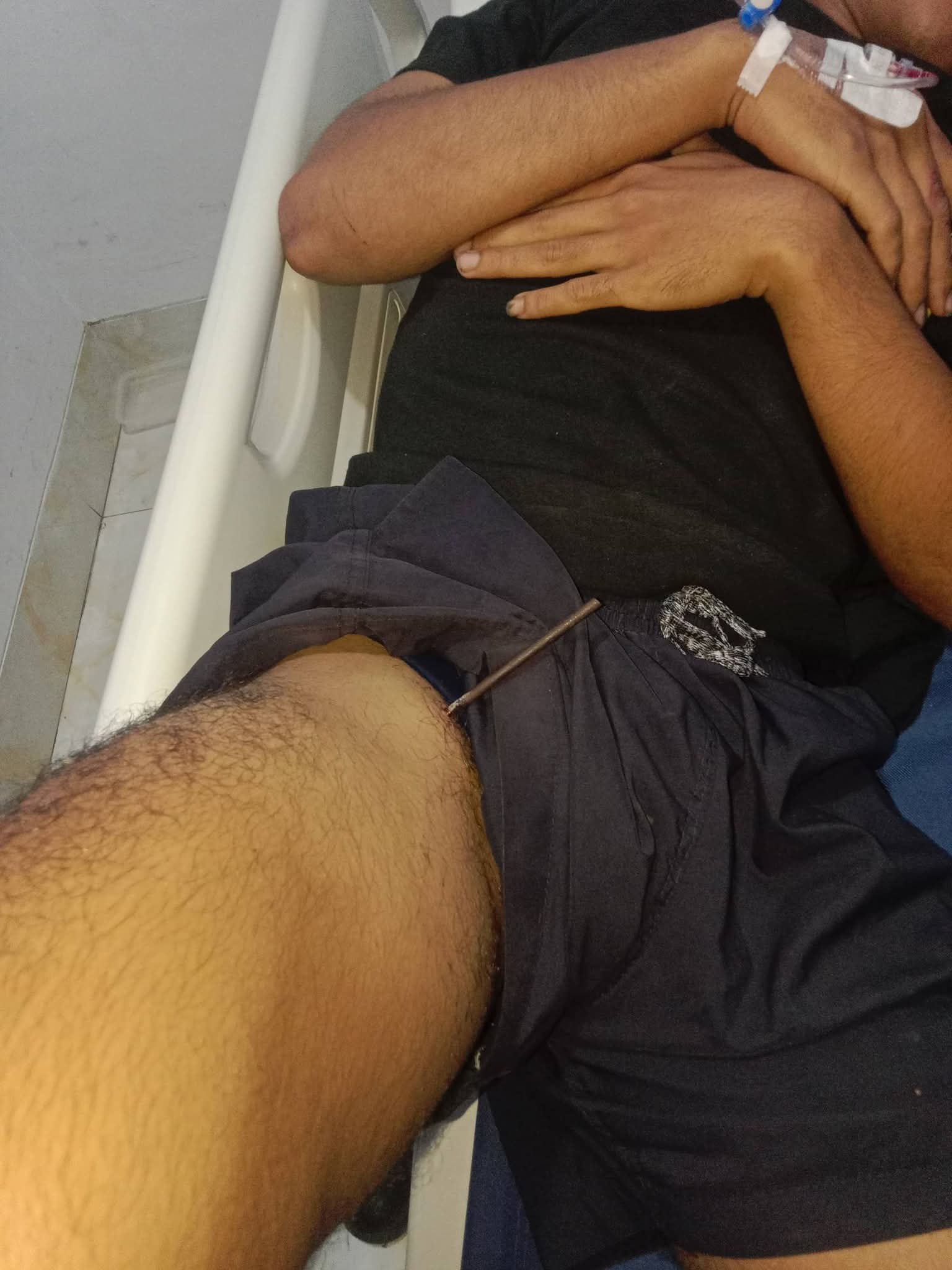 DARURAT! 24 JAM ANAK PANAH MASIH MENANCAP DI PAHA ANAK, KELUARGA MOHON BANTUAN PENANGANAN MEDIS MANADO, SULAWESI UTARA —